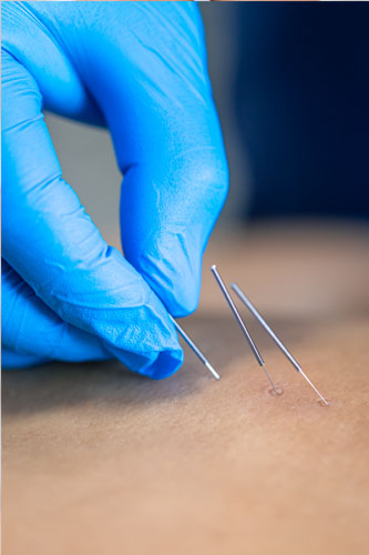 dryneedling
